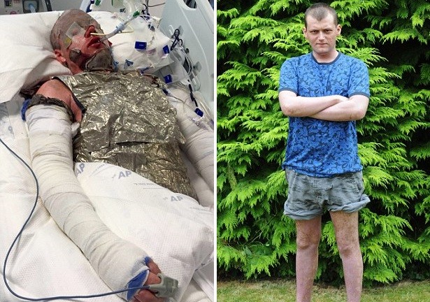Британец едва не умер из-за жуткой аллергии на таблетки
