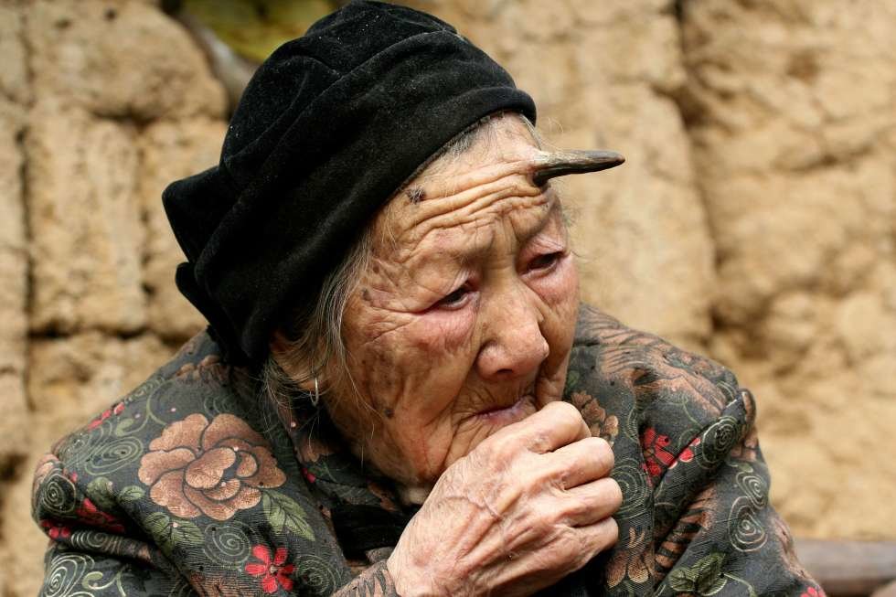 У 101-летней китаянки во лбу вырос рог